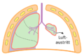 Pneumothorax.png